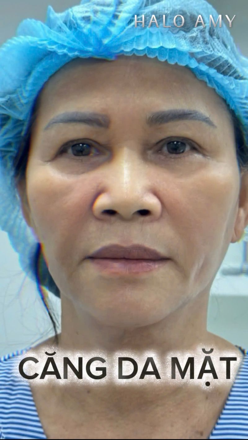 CĂNG DA MẶT