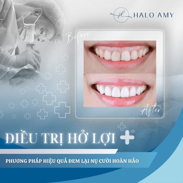 Điều trị cười hở lợi và 7+ Cách Hiệu Quả Đem Lại Nụ Cười Hoàn Hảo tại Halo Amy